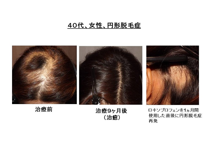 円形脱毛症　病院""